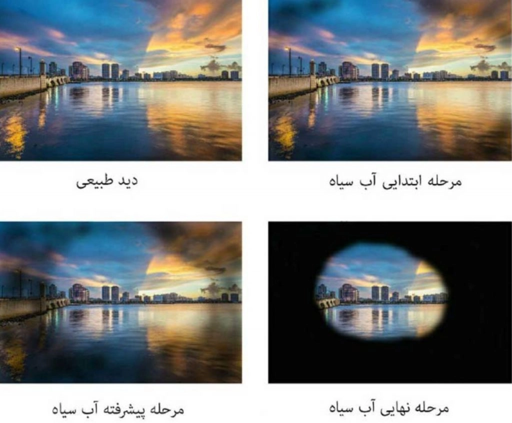 همه چیز در مورد بیماری گلوکوم یا آب سیاه و روش های درمان آن